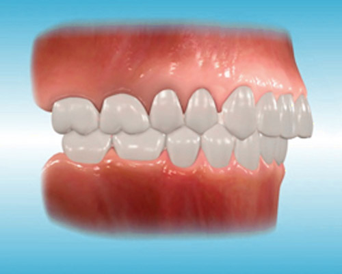 overbite problem diagram