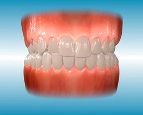 cross bite problem diagram